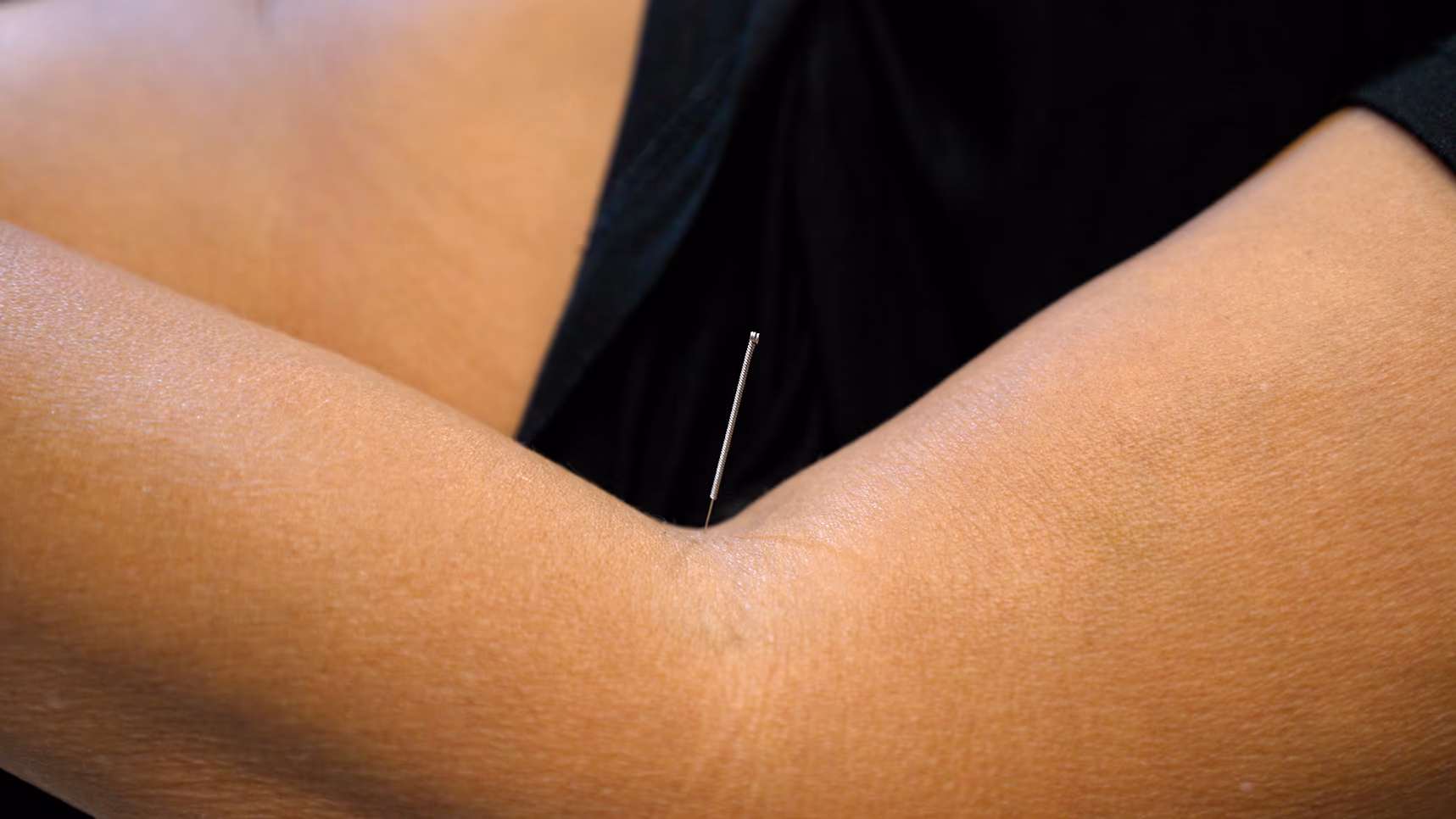 Bodylogics acupuncture treatment