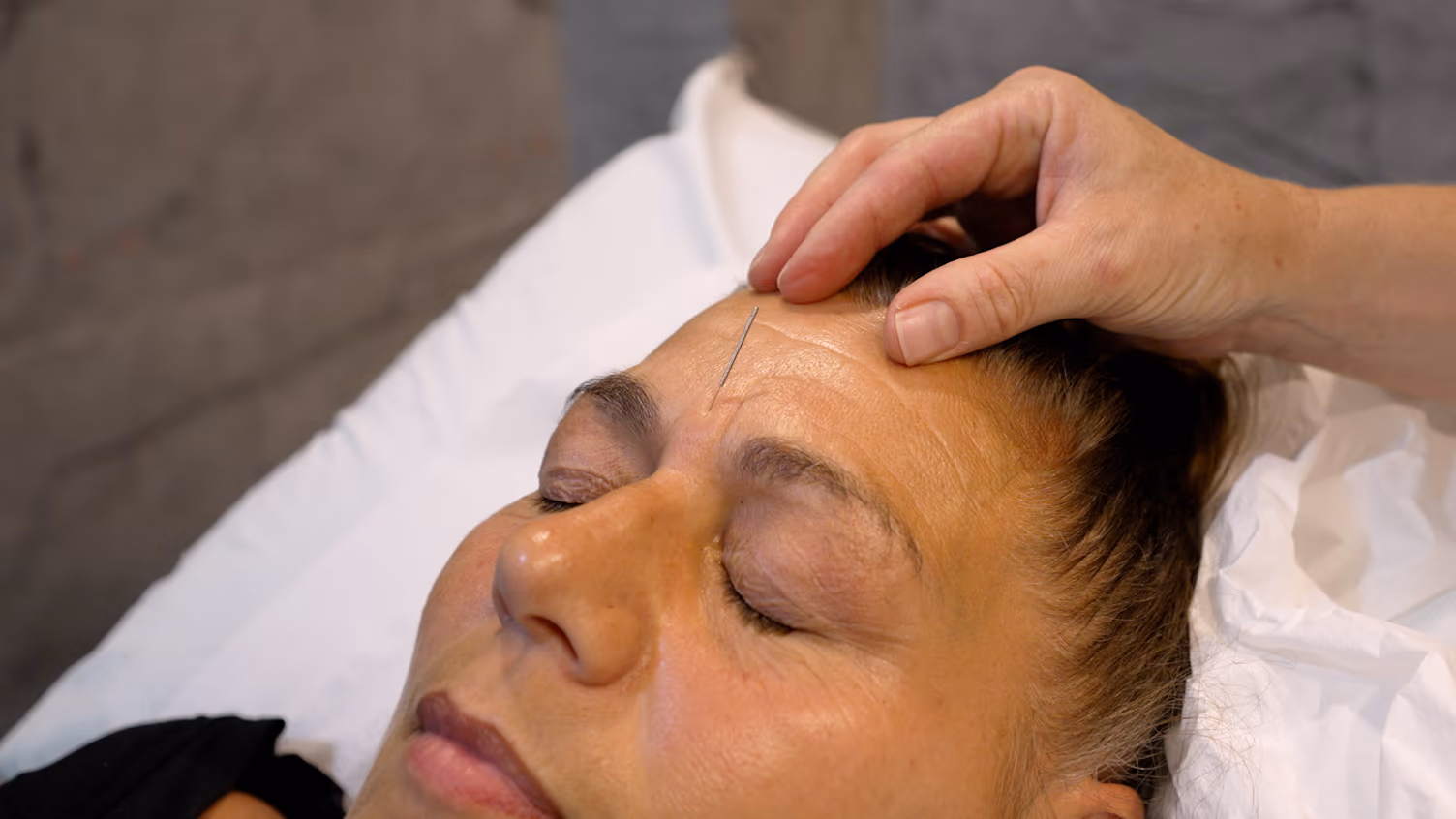 Acupuncture needles being applied
